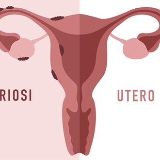 Endometriosi: cos´è e come riconoscerla